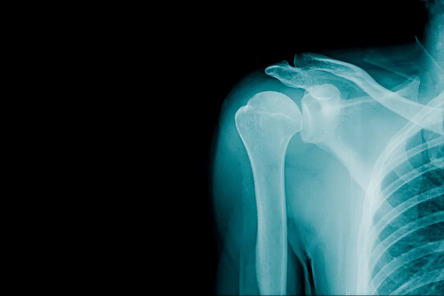 Røntgenbilde av skulder