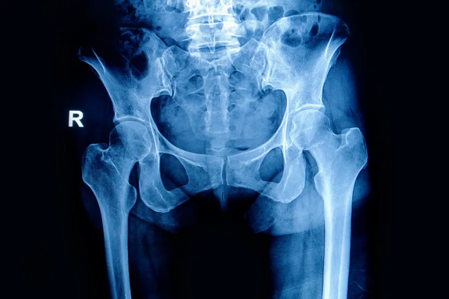 Røntgenbilde av hofte
