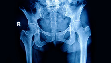 Røntgenbilde av hofte